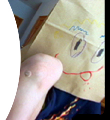 boy with his wart